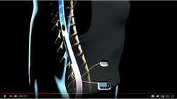 medical breathrough wireless spinal implant