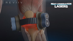 A closeup shows an artist's rendering of a human knee, x-ray style view, showing muscle and bone with redness at the knee joint. Two dark gray devices are on each side of the knee with a strap in between.